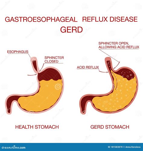 Heartburn and Gastroesophageal Reflux Disease GERD.Concept Health Stock ...