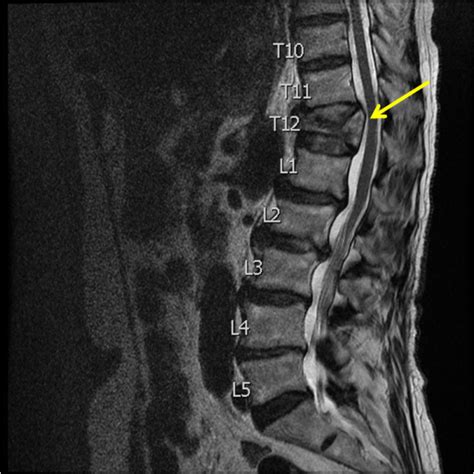 T7 Compression Fracture