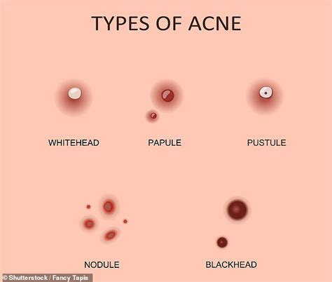 The six types of pimple and how to deal with each one - Hot World Report