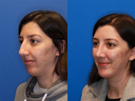 Nose Surgery Before & After Photos Patient 282 | San Francisco, CA | Kaiser Permanente Cosmetic ...