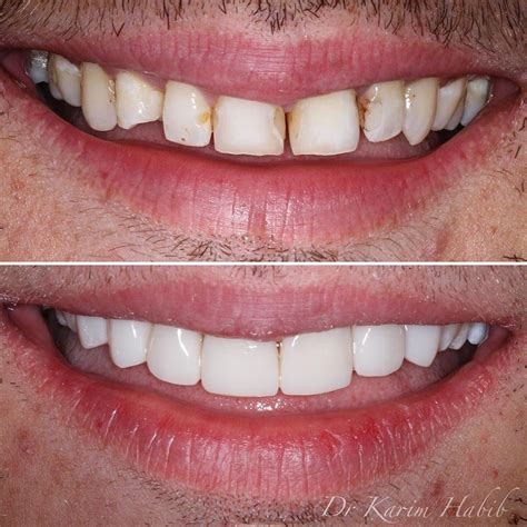 Composite Veneers Sydney | Dental Bonding Sydney - Dentist Ryde | Gladesville | Putney | North Ryde