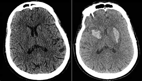 Bilateral Basal Ganglia Hemorrhage in a Patient with Confirmed COVID-19 | American Journal of ...