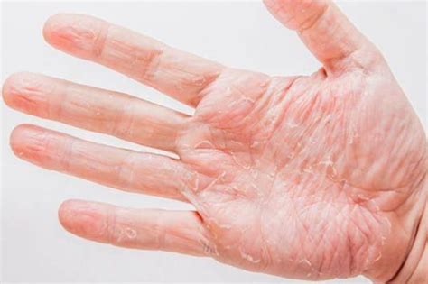 7 Home Remedies for Dry Cracked Hands - Skin Care Geeks