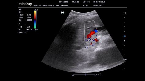 Portal Vein Measurement Ultrasound