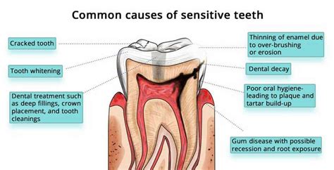 Tooth Sensitivity: Causes, Treatment, and Prevention