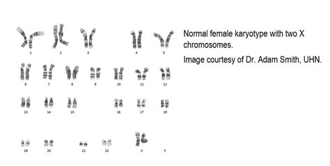 Syndromes Karyotype