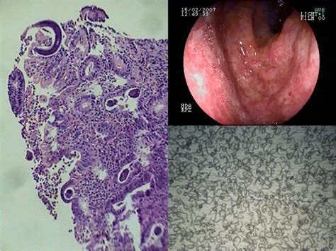 Infection and Hyperinfection with Strongyloides stercoralis: Clinical ...