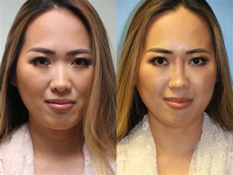 Non-Surgical Rhinoplasty photos | Chevy Chase, MD | Patient 11854