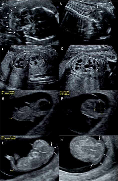 Figure 1 from The First Reported Case of Meckel–Gruber Syndrome Associated With Abnormal ...