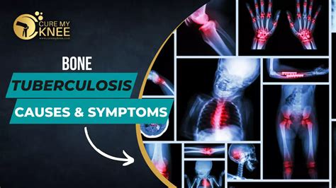 Bone Tuberculosis (TB): Causes, Symptoms, Types, Treatment