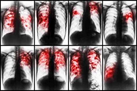 Silicosis : Causes, symptoms, complication, & treatment | FactDr