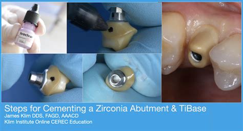 Cementing a Zirconia Abutment and TiBase | CADStar