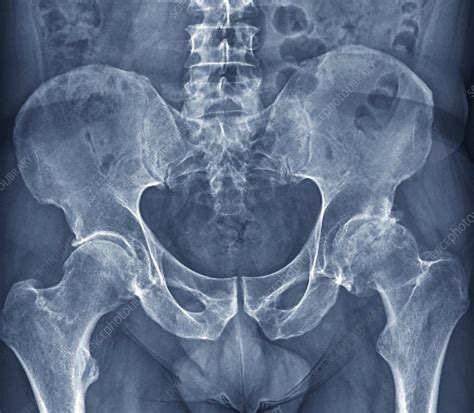 Osteoarthritis of the hip, X-ray - Stock Image - F006/3744 - Science ...
