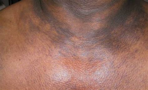 Dark Spots on Neck, Chest, Shoulder Causes and Cure - Skincarederm