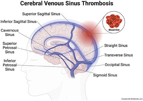 Transverse Sinus Thrombosis