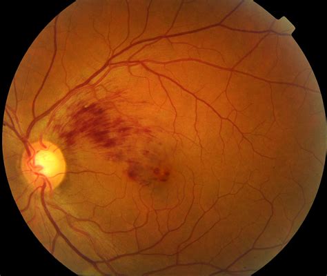 7 Different Retinal Diseases You Need to Know – Miosuperhealth