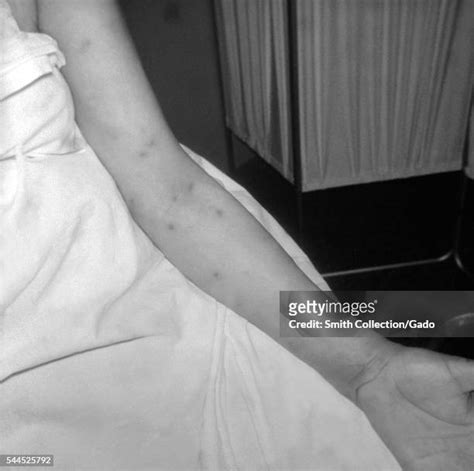 Red Rash Arm Photos and Premium High Res Pictures - Getty Images