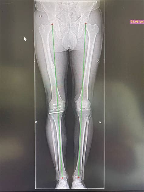 Checklist for knee cartilage transplant: Tips to prepare your body and mind | by Debashish ...