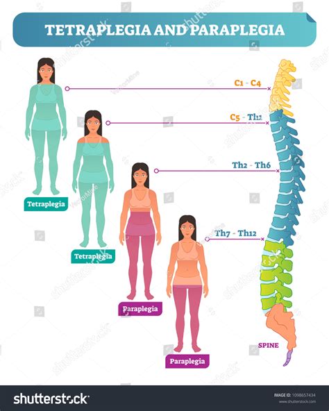 53 imagens de Tetraplegia Imagens, fotos stock e vetores | Shutterstock