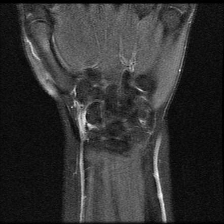 Radial collateral ligament of the wrist | Radiology Reference Article ...