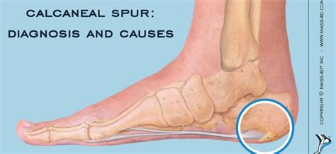 Calcaneal enthesophyte: symptoms and treatments – Healthy Food Near Me