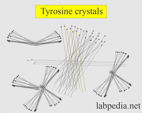 Urine Crystals (Crystalluria) - Labpedia.net