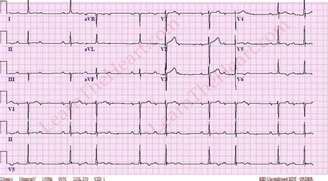 Second Degree AV Block Type I (Wenkebach) ECG (Example 2) | Learn the Heart