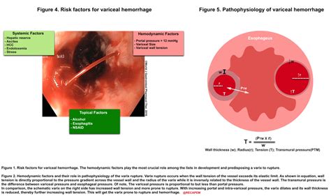 The Critical Gastrointestinal Hemorrhage: Evidence-Based Management - RECAPEM