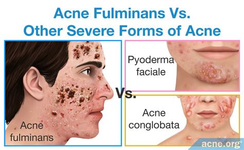 What Is Acne Fulminans? - Acne.org