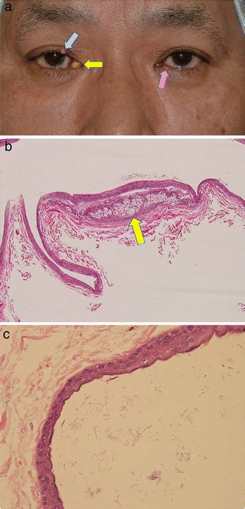 Steatocystoma simplex of the lacrimal caruncle: a case report | BMC ...