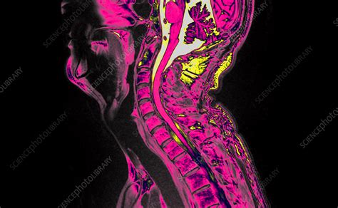 Slipped disc, MRI scan - Stock Image - C058/2818 - Science Photo Library