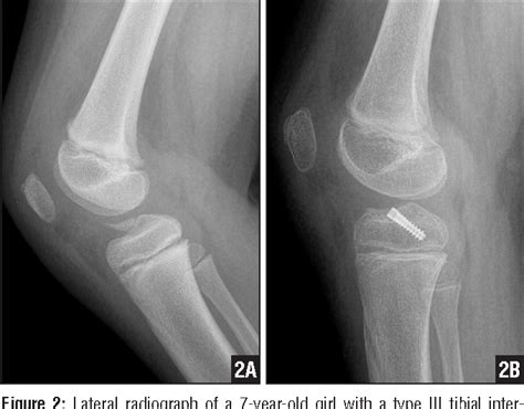 Tibial Intercondylar Eminence