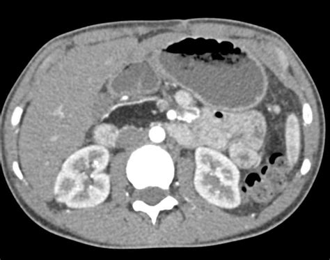 Cystic Fibrosis with Fatty Replacement of the Pancreas - Pancreas Case ...