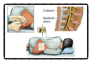 [의학멘토링] Epidural Blood Patch : 네이버 블로그