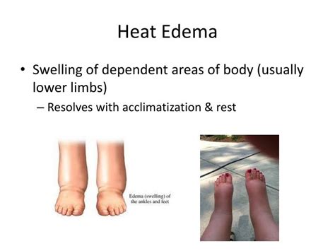 PPT - Heat Related Illness PowerPoint Presentation - ID:2506046