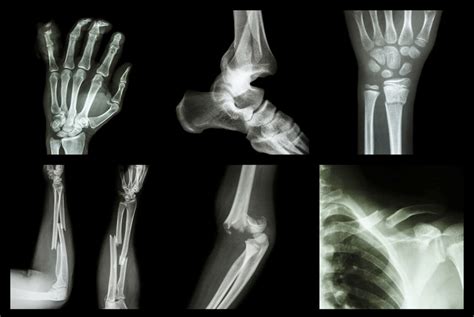 6 Ways To Help Heal Broken Bones Faster