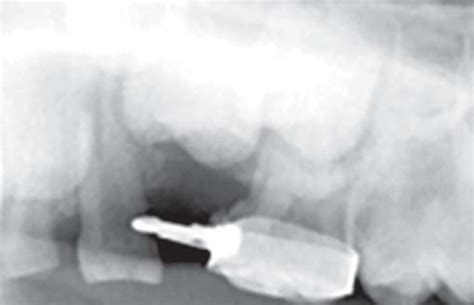 Band and loop space maintainer placed after extraction of submerged ...