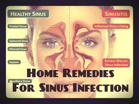 Sphenoid Sinusitis Symptoms Headache - Headache