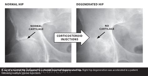 The different kinds of injections for bone on bone hip – Caring Medical Florida