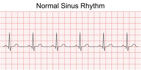 Normal Ecg Reading