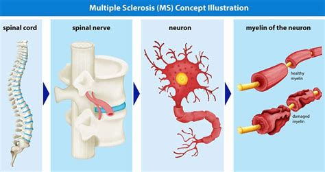 Multiple Sclerosis Stem Cell Treatment, Therapy, Therapeutic ...