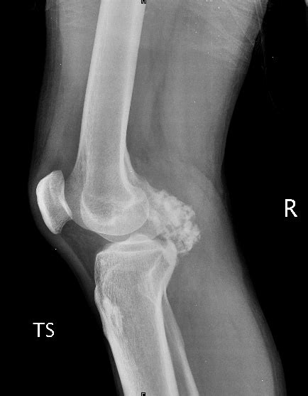 X-ray of the right knee showing a calcified mass in the popliteal... | Download Scientific Diagram