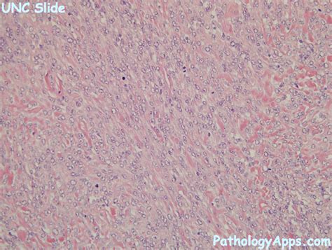 Fibrosarcoma Histology