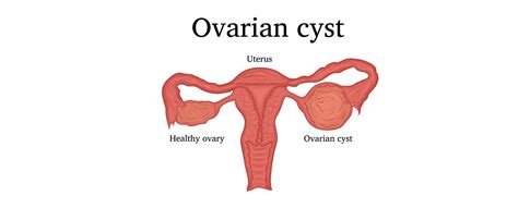 Ovarian Cystectomy | Procedure & Cost in India