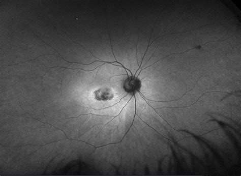 Plaquenil Toxicity: How to Avoid this Bullseye