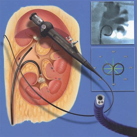 RIRS (Retrograde Intrarenal Surgery) - Gabani Kidney Hospital - Complete Urology Hospital, Surat