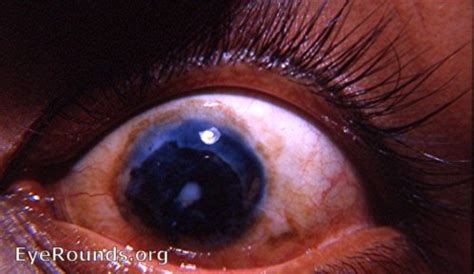 Tattooed cornea. EyeRounds.org: Online Ophthalmic Atlas