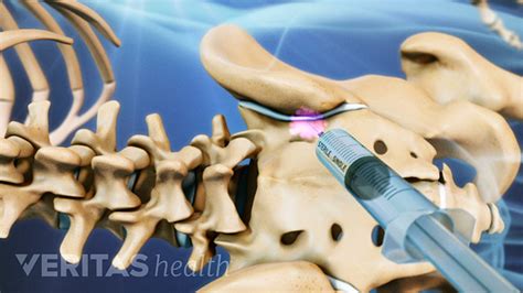 Understanding Sacroiliac Joint Injections