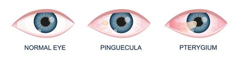 Pinguecula: Causes & Treatment Options