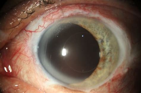 Aniridia - Absence of the iris Often occurs bilaterally. It may have a congenital origin or ...